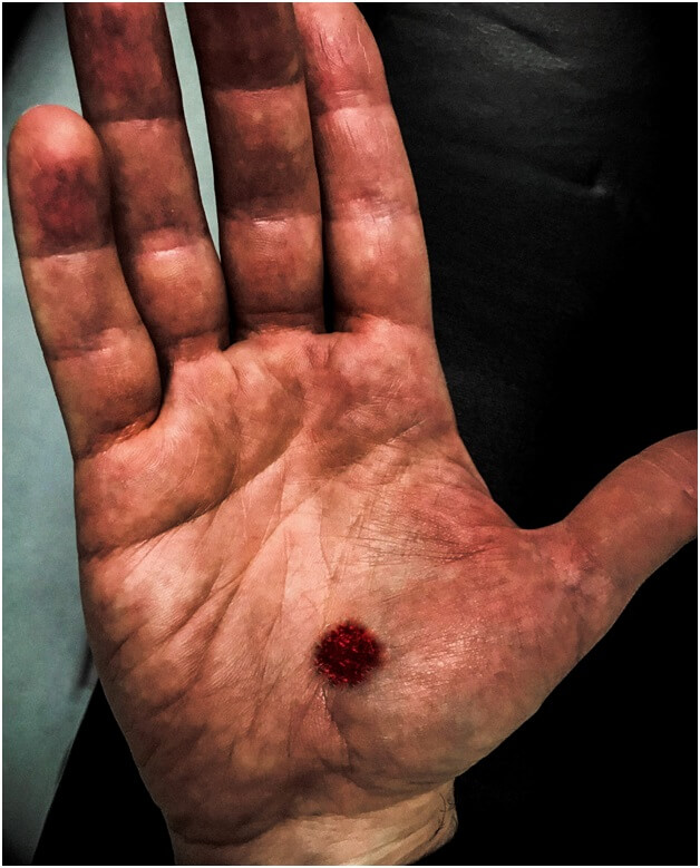 nails hole thumb