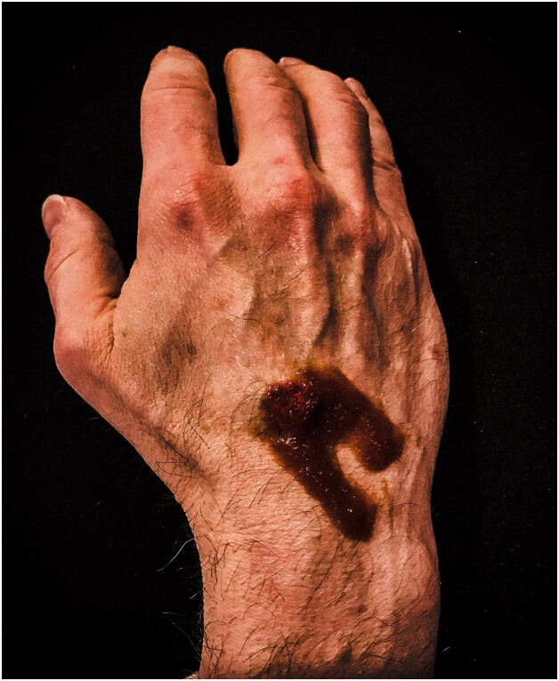 nails blood
